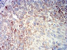 BCL2L10 / Diva Antibody - Immunohistochemical analysis of paraffin-embedded lung cancer tissues using BCL2L10 mouse mAb with DAB staining.