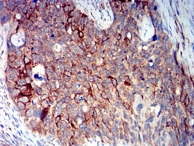 BCL2L10 / Diva Antibody - Immunohistochemical analysis of paraffin-embedded cervical cancer tissues using BCL2L10 mouse mAb with DAB staining.