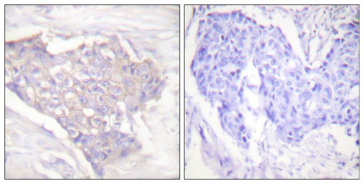 BCL2L11 / BIM Antibody - Immunohistochemistry analysis of paraffin-embedded human breast carcinoma tissue, using BIM Antibody. The picture on the right is blocked with the synthesized peptide.