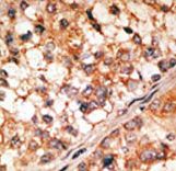 BCL2L11 / BIM Antibody - Formalin-fixed and paraffin-embedded human cancer tissue reacted with the primary antibody, which was peroxidase-conjugated to the secondary antibody, followed by DAB staining. This data demonstrates the use of this antibody for immunohistochemistry; clinical relevance has not been evaluated. BC = breast carcinoma; HC = hepatocarcinoma.