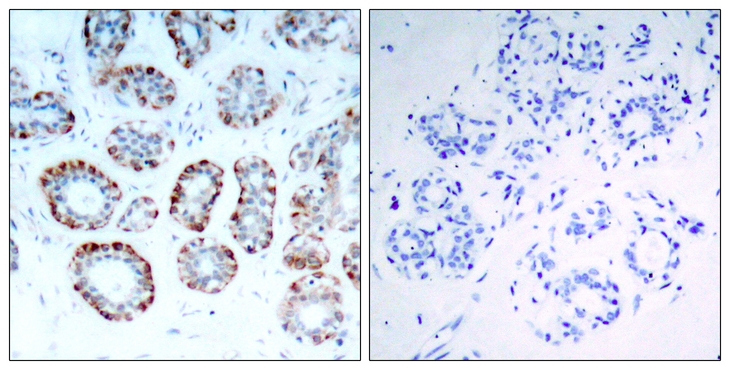 BCL2L11 / BIM Antibody - Immunohistochemistry of paraffin-embedded human breast carcinoma tissue using BIM(Ab-69) antibody (left) or the same antibody preincubated with blocking peptide (right).