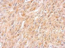 BCL2L12 Antibody - BCL2L12 antibody detects BCL2L12 protein at cytosol on U87 xenograft by immunohistochemical analysis. Sample: Paraffin-embedded U87 xenograft. BCL2L12 antibody dilution:1:500.