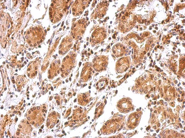 BCL2L12 Antibody - BCL2L12 antibody detects BCL2L12 protein at cytosol and nucleus on colon carcinoma by immunohistochemical analysis. Sample: Paraffin-embedded colon carcinoma tissue. BCL2L12 antibody dilution:1:500.