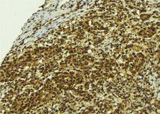 BCL2L13 / Bcl Rambo Antibody - 1:100 staining human breast carcinoma tissue by IHC-P. The sample was formaldehyde fixed and a heat mediated antigen retrieval step in citrate buffer was performed. The sample was then blocked and incubated with the antibody for 1.5 hours at 22°C. An HRP conjugated goat anti-rabbit antibody was used as the secondary.