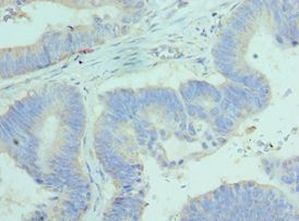 BCL2L14 / BCL-G Antibody - Immunohistochemistry of paraffin-embedded human colon cancer using antibody at 1:100 dilution.