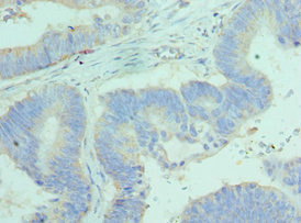BCL2L14 / BCL-G Antibody - Immunohistochemistry of paraffin-embedded human colon cancer using BCL2L14 Antibody at dilution of 1:100