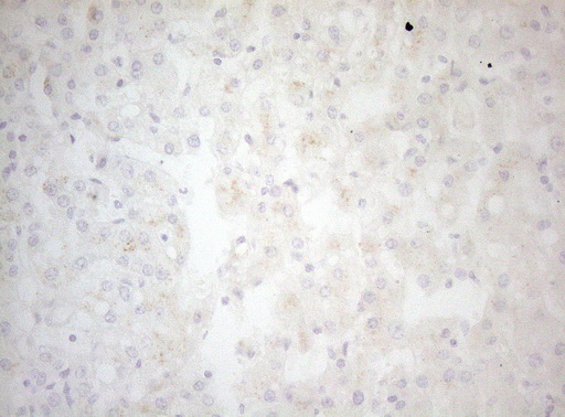 BCL2L14 / BCL-G Antibody - Immunohistochemical staining of paraffin-embedded Carcinoma of Human liver tissue using anti-BCL2L14 mouse monoclonal antibody. (Heat-induced epitope retrieval by 1mM EDTA in 10mM Tris buffer. (pH8.5) at 120°C for 3 min. (1:150)