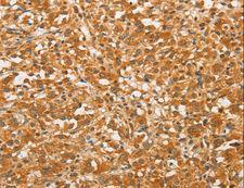 BCL2L14 / BCL-G Antibody - Immunohistochemistry of paraffin-embedded Human colon cancer using BCL2L14 Polyclonal Antibody at dilution of 1:40.