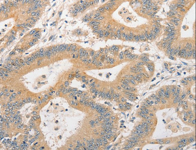 BCL2L14 / BCL-G Antibody - Immunohistochemistry of paraffin-embedded Human colon cancer using BCL2L14 Polyclonal Antibody at dilution of 1:40.