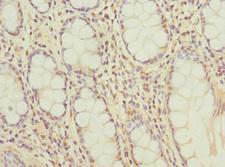 BCL2L15 Antibody - Immunohistochemistry of paraffin-embedded human colon cancer at dilution 1:100