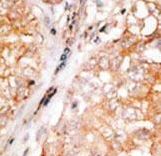 BCL2L2 / Bcl-w Antibody - Formalin-fixed and paraffin-embedded human cancer tissue reacted with the primary antibody, which was peroxidase-conjugated to the secondary antibody, followed by DAB staining. This data demonstrates the use of this antibody for immunohistochemistry; clinical relevance has not been evaluated. BC = breast carcinoma; HC = hepatocarcinoma.