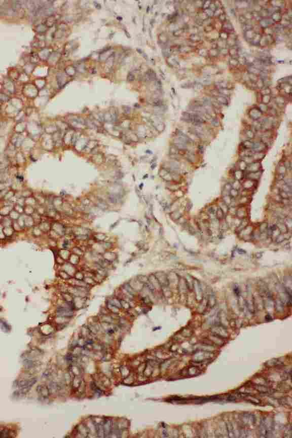 BCL2L2 / Bcl-w Antibody - IHC analysis of BCL2L2 using anti-BCL2L2 antibody. BCL2L2 was detected in paraffin-embedded section of human rectal cancer tissues. Heat mediated antigen retrieval was performed in citrate buffer (pH6, epitope retrieval solution) for 20 mins. The tissue section was blocked with 10% goat serum. The tissue section was then incubated with 1µg/ml rabbit anti-BCL2L2 Antibody overnight at 4°C. Biotinylated goat anti-rabbit IgG was used as secondary antibody and incubated for 30 minutes at 37°C. The tissue section was developed using Strepavidin-Biotin-Complex (SABC) with DAB as the chromogen.