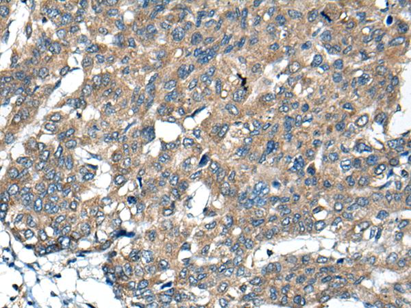 BCL2L2 / Bcl-w Antibody - Immunohistochemistry of paraffin-embedded Human liver cancer tissue  using BCL2L2 Polyclonal Antibody at dilution of 1:40(×200)