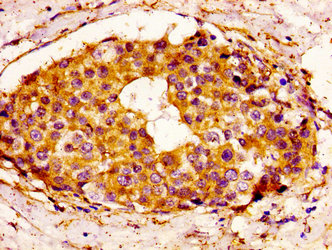 BCL3 / BCL-3 Antibody - Immunohistochemistry image at a dilution of 1:100 and staining in paraffin-embedded human breast cancer performed on a Leica BondTM system. After dewaxing and hydration, antigen retrieval was mediated by high pressure in a citrate buffer (pH 6.0) . Section was blocked with 10% normal goat serum 30min at RT. Then primary antibody (1% BSA) was incubated at 4 °C overnight. The primary is detected by a biotinylated secondary antibody and visualized using an HRP conjugated SP system.