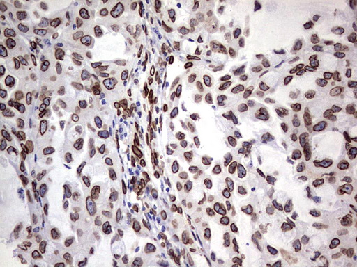 BCL6 Antibody - Immunohistochemical staining of paraffin-embedded Carcinoma of Human lung tissue using anti-BCL6 mouse monoclonal antibody.