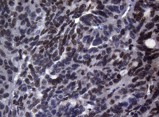 BCL6 Antibody - Immunohistochemical staining of paraffin-embedded Adenocarcinoma of Human ovary tissue using anti-BCL6 mouse monoclonal antibody.