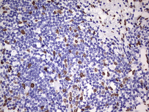 BCL6 Antibody - Immunohistochemical staining of paraffin-embedded Carcinoma of Human pancreas tissue using anti-BCL6 mouse monoclonal antibody.