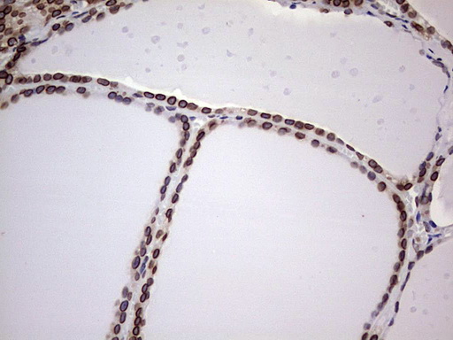 BCL6 Antibody - Immunohistochemical staining of paraffin-embedded Human thyroid tissue using anti-BCL6 mouse monoclonal antibody.