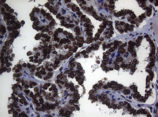 BCL6 Antibody - Immunohistochemical staining of paraffin-embedded Carcinoma of Human thyroid tissue using anti-BCL6 mouse monoclonal antibody. (Heat-induced epitope retrieval by 1mM EDTA in 10mM Tris buffer. (pH8.5) at 120°C for 3 min. (1:150)