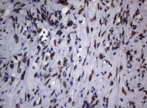 BCL6 Antibody - Immunohistochemical staining of paraffin-embedded Carcinoma of Human bladder tissue using anti-BCL6 mouse monoclonal antibody.