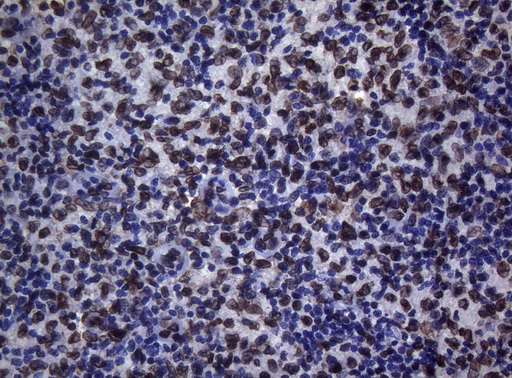 BCL6 Antibody - Immunohistochemical staining of paraffin-embedded Human lymph node tissue using anti-BCL6 mouse monoclonal antibody.