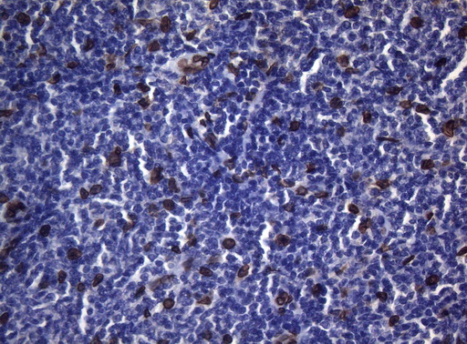 BCL6 Antibody - Immunohistochemical staining of paraffin-embedded Human lymphoma tissue using anti-BCL6 mouse monoclonal antibody.