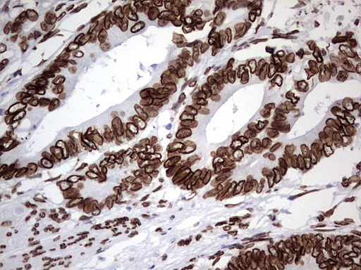BCL6 Antibody - Immunohistochemical staining of paraffin-embedded Adenocarcinoma of Human colon tissue using anti-BCL6 mouse monoclonal antibody.