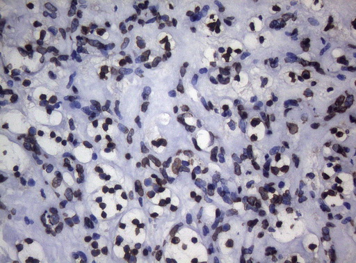 BCL6 Antibody - Immunohistochemical staining of paraffin-embedded Carcinoma of Human kidney tissue using anti-BCL6 mouse monoclonal antibody.