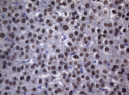 BCL6 Antibody - Immunohistochemical staining of paraffin-embedded Human liver tissue using anti-BCL6 mouse monoclonal antibody.