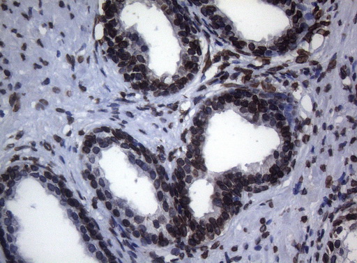 BCL6 Antibody - Immunohistochemical staining of paraffin-embedded Carcinoma of Human prostate tissue using anti-BCL6 mouse monoclonal antibody.