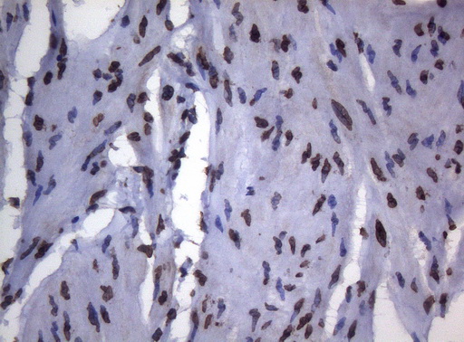 BCL6 Antibody - Immunohistochemical staining of paraffin-embedded Human bladder tissue using anti-BCL6 mouse monoclonal antibody.