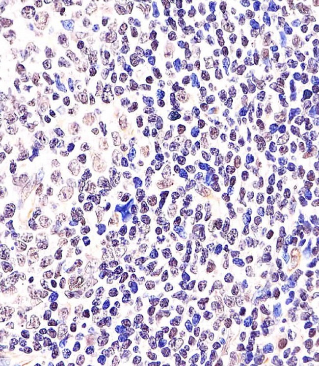 BCL6 Antibody - Antibody staining BCL6 in Human tonsil tissue sections by Immunohistochemistry (IHC-P - paraformaldehyde-fixed, paraffin-embedded sections). Tissue was fixed with formaldehyde and blocked with 3% BSA for 0. 5 hour at room temperature; antigen retrieval was by heat mediation with a citrate buffer (pH 6). Samples were incubated with primary antibody (1:25) for 1 hours at 37°C. A undiluted biotinylated goat polyvalent antibody was used as the secondary antibody.