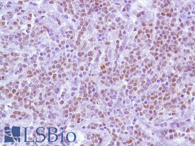 BCL6 Antibody - Immunohistochemistry of Human B-Cell Lymphoma stained with anti-BCL-6 antibody