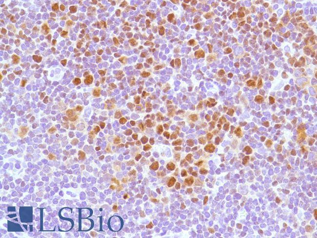 BCL6 Antibody - Immunohistochemistry of Human Follicular Lymphoma stained with anti-BCL-6 antibody