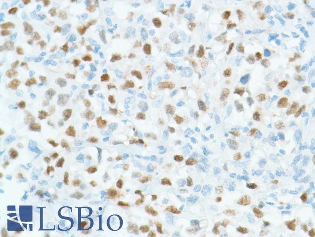 BCL6 Antibody - Immunohistochemistry of Human Diffuse B-Cell Lymphoma stained with anti-BCL-6 antibody