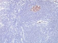 BCL6 Antibody - Formalin-fixed, paraffin-embedded human lymphoma stained with anti-Bcl6 antibody (SPM602).