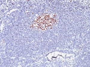BCL6 Antibody - IHC testing of formalin-fixed, paraffin-embedded human lymphoma stained with anti-Bcl6 antibody (clone SPM602).