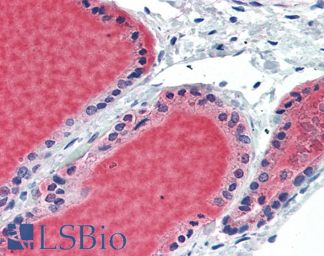 BCL6 Antibody - Thyroid: Formalin-Fixed, Paraffin-Embedded (FFPE)
