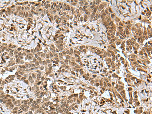 BCL7B Antibody - Immunohistochemistry of paraffin-embedded Human ovarian cancer tissue  using BCL7B Polyclonal Antibody at dilution of 1:85(×200)