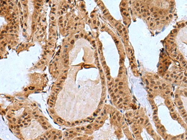 BCL7B Antibody - Immunohistochemistry of paraffin-embedded Human thyroid cancer tissue  using BCL7B Polyclonal Antibody at dilution of 1:85(×200)