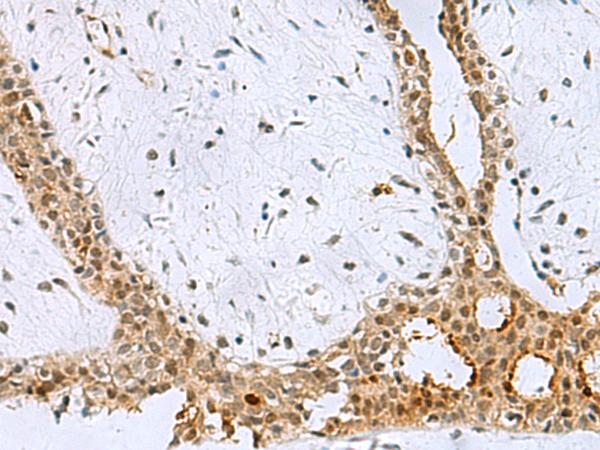 BCL7B Antibody - Immunohistochemistry of paraffin-embedded Human breast cancer tissue  using BCL7B Polyclonal Antibody at dilution of 1:60(×200)