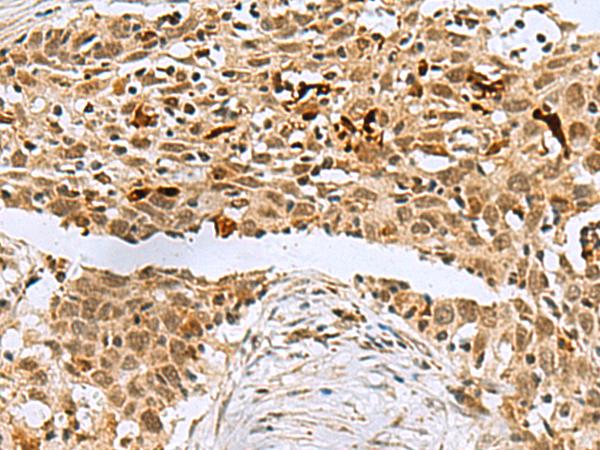 BCL7B Antibody - Immunohistochemistry of paraffin-embedded Human esophagus cancer tissue  using BCL7B Polyclonal Antibody at dilution of 1:60(×200)
