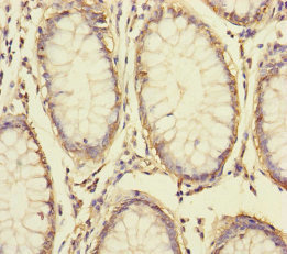 BCMP84 / S100A14 Antibody - Immunohistochemistry of paraffin-embedded human colon cancer at dilution of 1:100