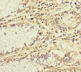 BCO1 / BCMO1 Antibody - Immunohistochemistry of paraffin-embedded human colon cancer using BCO1 Antibody at dilution of 1:100