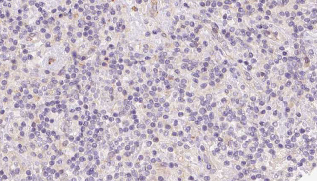 BCO2 / BCDO2 Antibody - 1:100 staining human lymph carcinoma tissue by IHC-P. The sample was formaldehyde fixed and a heat mediated antigen retrieval step in citrate buffer was performed. The sample was then blocked and incubated with the antibody for 1.5 hours at 22°C. An HRP conjugated goat anti-rabbit antibody was used as the secondary.