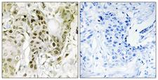 BCOR Antibody - Immunohistochemistry analysis of paraffin-embedded human breast carcinoma tissue, using BCOR Antibody. The picture on the right is blocked with the synthesized peptide.