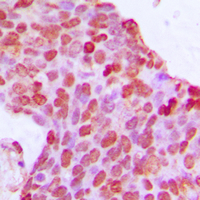 BCOR Antibody - Immunohistochemical analysis of BCOR staining in human breast cancer formalin fixed paraffin embedded tissue section. The section was pre-treated using heat mediated antigen retrieval with sodium citrate buffer (pH 6.0). The section was then incubated with the antibody at room temperature and detected using an HRP-conjugated compact polymer system. DAB was used as the chromogen. The section was then counterstained with hematoxylin and mounted with DPX.