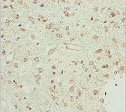 BCS1L Antibody - Immunohistochemistry of paraffin-embedded human glioma cancer at dilution 1:100