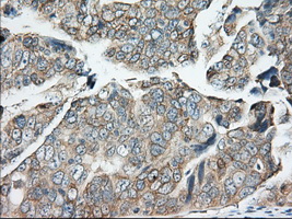 BDH2 Antibody - IHC of paraffin-embedded Adenocarcinoma of Human ovary tissue using anti-BDH2 mouse monoclonal antibody. (Dilution 1:50).