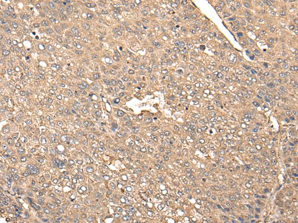 BDH2 Antibody - Immunohistochemistry of paraffin-embedded Human liver cancer tissue  using BDH2 Polyclonal Antibody at dilution of 1:65(×200)